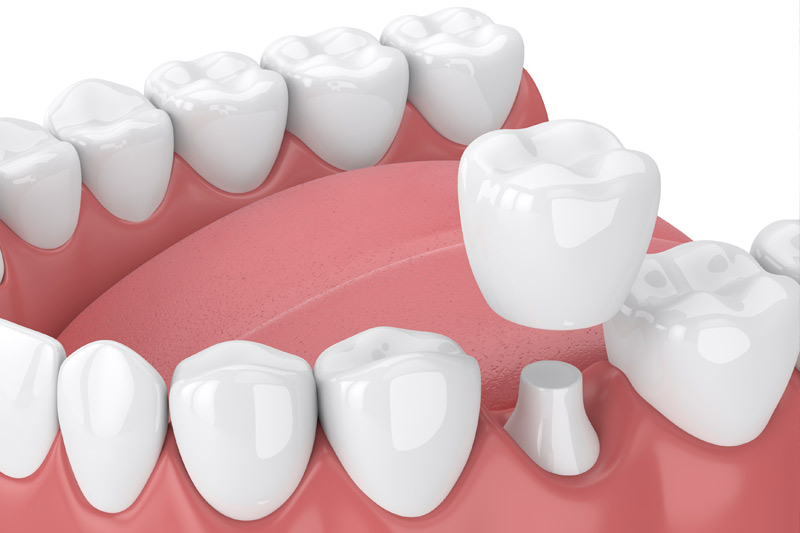 Dental Crowns in Spring