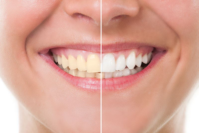 Teeth Whitening in Spring