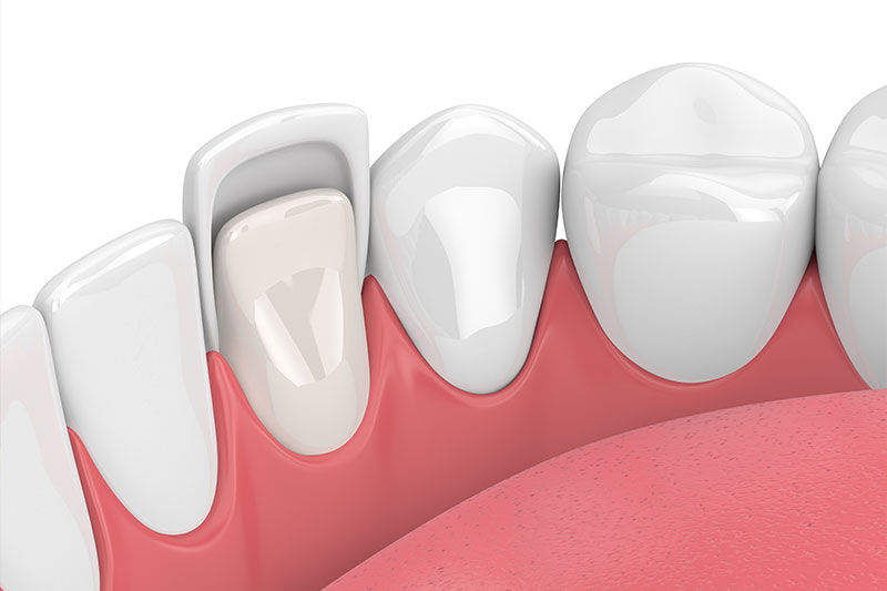 Porcelain Veneers in Spring