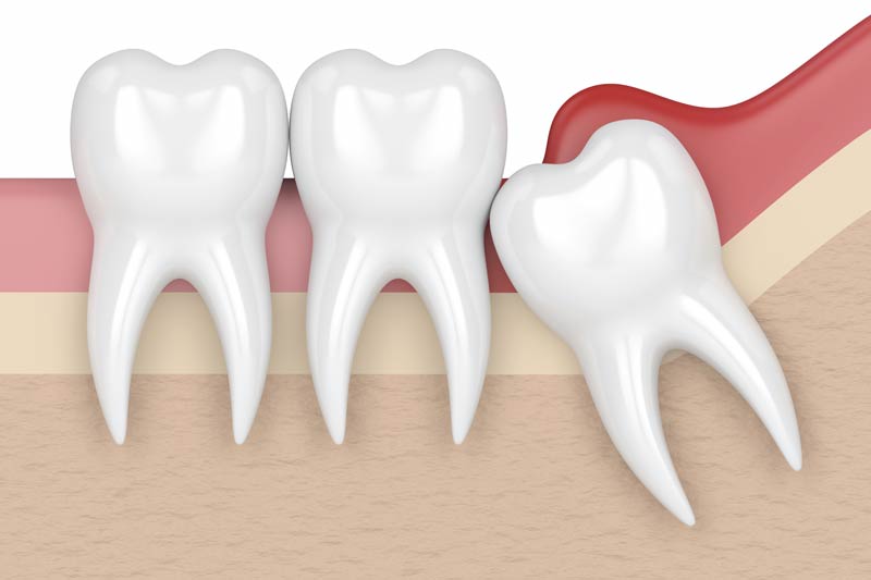 Wisdom Tooth Removal in Spring