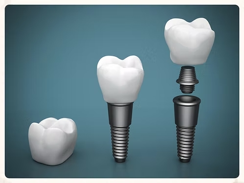 Single Tooth Replacement in Spring